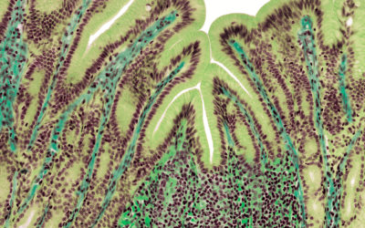 How to Repair Leaky Gut: No Fad Diets